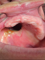 Rehabilitacja protetyczna po zabiegu częściowej resekcji szczęki