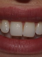 Estetyka uzupełnień protetycznych w przednim odcinku łuku zębowego