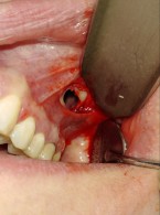 Torbiel zastoinowa lewej zatoki szczękowej o nietypowym przebiegu