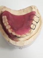 Rehabilitacja protetyczna u pacjentów z nabytym ubytkiem tkanek kości szczęk