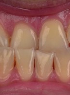 Poprawa estetyki uśmiechu po leczeniu ortodontycznym z wykorzystaniem płynnego kompozytu