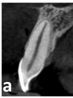 Ząb sieczny przyśrodkowy z czterema oddzielnymi kanałami korzeniowymi
