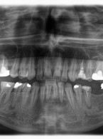 Jednowizytowe leczenie endodontyczne zębów 32 i 31