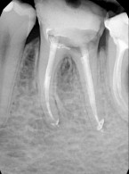 Postępowanie w przypadku złamania narzędzi endodontycznych