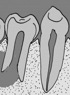 Rewaskularyzacja miazgi u dorosłego pacjenta w drugim zębie przedtrzonowym prawym żuchwy