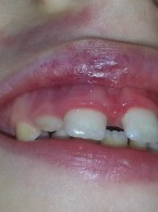 SPECJALISTA RADZI: Zapalenie kątów ust – czy to jedynie lokalny problem?