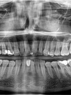 Niechirurgiczne leczenie zębopochodnych zmian chorobowych zatok szczękowych