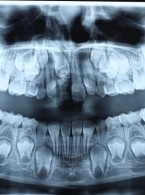 Zębiak zestawny – aktualny problem kliniczny