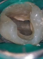 Nietypowa anatomia kanałów korzeniowych spotykana w codziennej praktyce endodoncji mikroskopowej