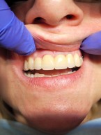 Powtórne leczenie endodontyczne 30 lat później