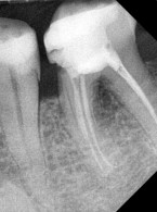 SPECJALISTA RADZI: Niechirurgiczne leczenie periodontologiczne vs leczenie chirurgiczne