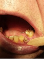 Wpływ leków antyresorpcyjnych na stan jamy ustnej