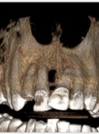 ARTYKUŁ Z FILMEM. Warunkowe leczenie endodontyczne zębów 12 i 11 – obserwacje 2-letnie