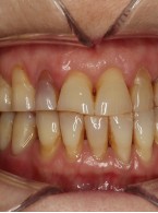 Wylew krwi do miazgi zęba jako następstwo urazu zgryzowego