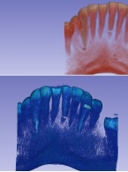Leczenie złamania wewnątrzzębodołowego dolnego zęba siecznego