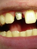 Zamknięcie szerokiego otworu wierzchołkowego w zębie siecznym