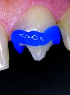 Odbudowa zębów przednich z wykorzystaniem innowacyjnej technologii ORMOCER®