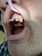 Odbudowa bezpośrednia korony zęba leczonego endodontycznie