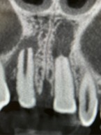 Leczenie powikłań po zwichnięciu całkowitym i replantacji zębów 11 i 21 u pacjentki młodocianej. Obserwacja 3-letnia