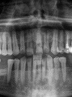 Leczenie endodontyczne zęba z szerokim otworem wierzchołkowym