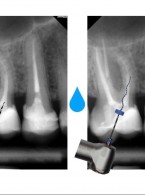 Selektywne rewizyjne leczenie endodontyczne zęba trzonowego górnego ze złożoną budową anatomiczną kanału mezjalnego bliższego. Opis przypadku