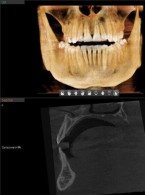 Uniknąć skalpela – endodontyczna  regeneracja kości 