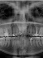Diagnostyka resorpcji zewnętrznej  drugiego zęba trzonowego