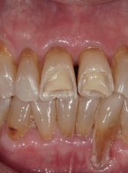 Jednostronne podniesienie zgryzu  z zastosowaniem mostu cyrkonowego