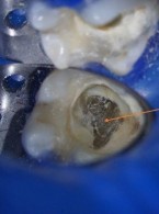 Leczenie kanałowe zęba trzonowego  dolnego z zębiniakiem