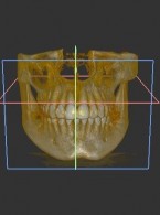 Analiza długości szwu podniebiennego  przy użyciu tomografii komputerowej  wiązki stożkowej