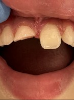 Leczenie endodontyczne zęba 11 z niezakończonym rozwojem korzenia – opis przypadku – Magda Skręty, Patrycja Ostrowska, Agnieszka Kus-Bartoszek, Aleksandra Wdowiak-Szymanik, Anna Jarząbek