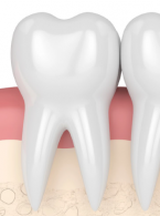 Opis przypadku innowacyjnej metody leczenia chirurgicznego pionowych złamań korzeni zębów bocznych w 24-miesięcznej obserwacji