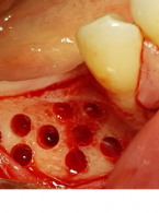Artykuł w wolnym dostępie Opis przypadku. Augmentacja boczna wąskich wyrostków...