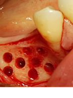 Augmentacja boczna wąskich wyrostków zębodołowych z zastosowaniem dwufazowego siarczanu wapnia – opis przypadku