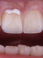 Bezpośrednia licówka kompozytowa w odcinku przednim wykonana z użyciem uniwersalnego kompozytu typu bulk-fill z uproszczonym systemem odcieni – opis przypadku klinicznego