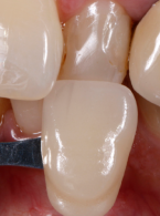 Odbudowa pewności siebie po urazie: podejście biomimetyczne – reportaż kliniczny