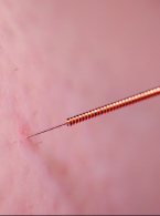 ﻿Suche igłowanie w leczeniu bólu mięśniowo-powięziowego. Mechanizmy działania i efekty terapeutyczne – praca przeglądowa