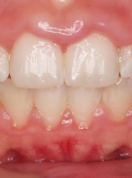 Chirurgiczne wydłużanie koron 