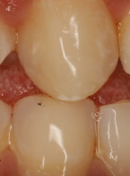 Bezpośrednia odbudowa prowadzenia na kłach