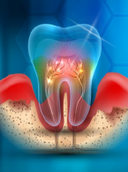Ryzyko choroby przyzębia u pacjentów z łuszczycą – przegląd piśmiennictwa