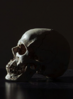 ARTYKUŁ ORYGINALNY. Osteosynteza w leczeniu złamań szczeki typu Le Fort I, II, III 