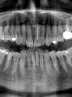 OPIS PRZYPADKU. Koncepcja zachowawczego postępowania w złamaniu koronowo-korzeniowym z użyciem materiału kompozytowego - opis przypadku