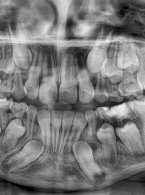OPIS PRZYPADKU. Złamanie trzonu żuchwy w wieku rozwojowym - opis przypadku