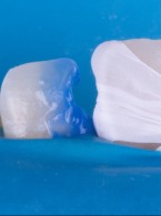 REPORTAŻ KLINICZNY. Przywracanie naturalnego uśmiechu. Technika warstwowej odbudowy kompozytowej - odcienie PREMIUM