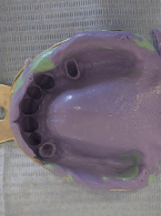 OPIS PRZYPADKU. Leczenie protetyczne z zastosowaniem protez szkieletowych klamrowych i bezklamrowych