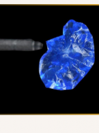 REPORTAŻ KLINICZNY. Flow Injection i technika stempla. Odbudowa zębów w odcinku bocznym