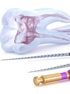 PROCEDURA. Odbudowa zębów leczonych endodontycznie