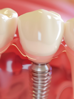 OPIS PRZYPADKU. Niepowodzenia odbudowy zębów leczonych endodontycznie - opis przypadków