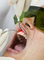 OPIS PRZYPADKU. Zastosowanie lasera CO2 w leczeniu leukopatii