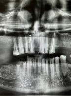 OPIS PRZYPADKU. Dwuetapowa rehabilitacja pacjenta z obniżoną wysokością zwarcia za pomocą pracy kombinowanej – opis przypadku 